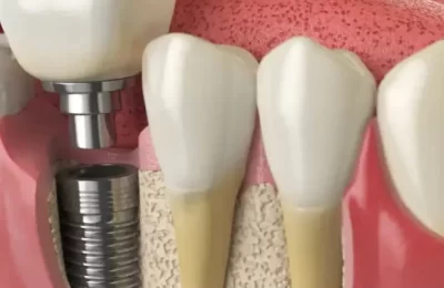 4 Types Of Dental Implants Explained