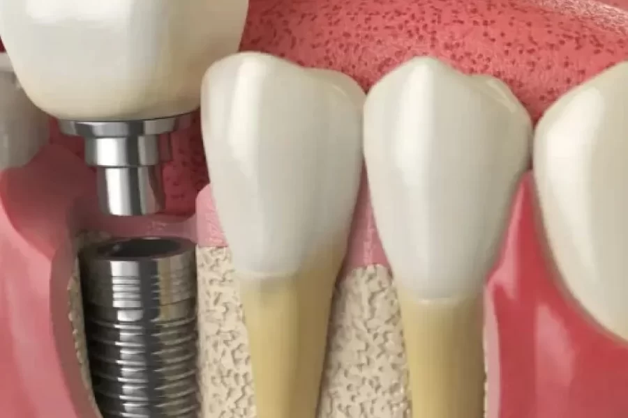 4 Types Of Dental Implants Explained