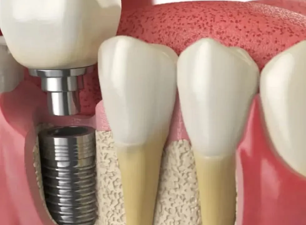 4 Types Of Dental Implants Explained